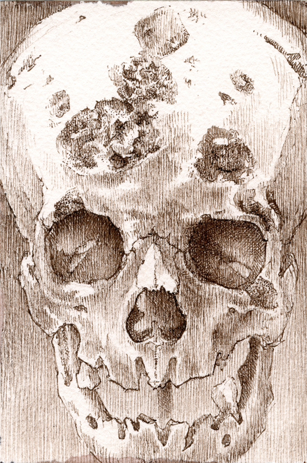 "No. 1161.07 – Syphilitic necrosis in female, age 26 (Mütter Museum)" is copyright © 2013 by James G. Mundie. All rights reserved.  Reproduction prohibited.